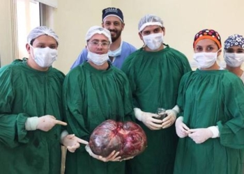 Una mujer tenia un tumor de 15 kilos en abdomen y pelvis