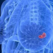 Un estudio revela que la mayoría de las mujeres con cáncer de mama podrían evitar la quimioterapia