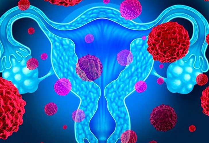 Estos tipos de cáncer suelen confundirse con otras afecciones