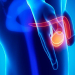 Cáncer testicular, ¿qué hombres son propensos a sufrirlo?