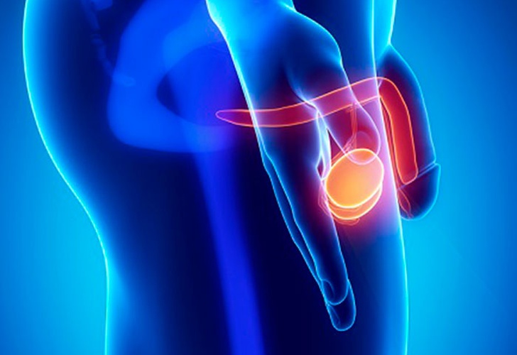 Cáncer testicular, ¿qué hombres son propensos a sufrirlo?