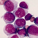 El 90 % de pacientes con leucemia mieloide mueren antes del tratamiento