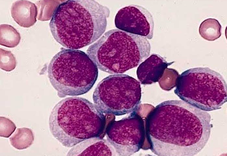 El 90 % de pacientes con leucemia mieloide mueren antes del tratamiento