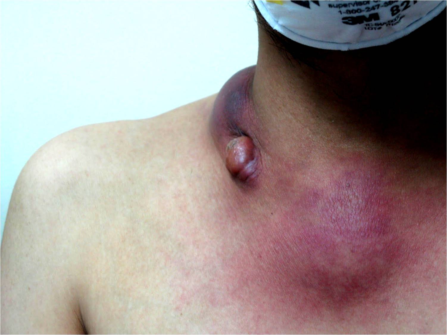 Otra enfermedad que se tornó mortal en Jujuy y es más común de lo que creías