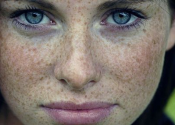 Pecas y lunares, ¿conoces la diferencia?