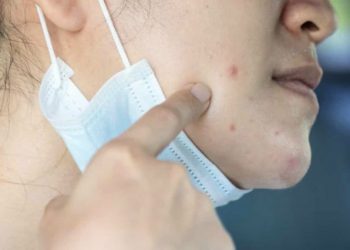 Descubre cómo tratar el acné producido por el uso de mascarillas contra el contagio del Covid-19