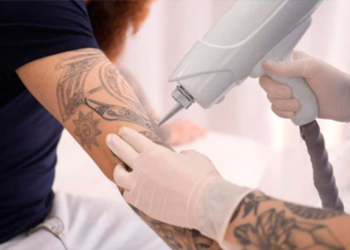 Nuevo láser permite borrar tatuajes en menos sesiones