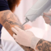 Nuevo láser permite borrar tatuajes en menos sesiones