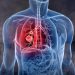 Una nueva droga aprobada en Argentina, abre una nueva esperanza en el tratamiento del cáncer de pulmón