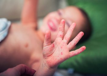 ¿Cómo diferenciar el virus manos, pies y boca y la varicela?
