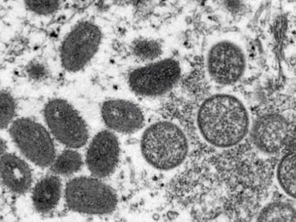 Irlanda del Norte detecta el primer caso de la viruela del mono – Notinor Jujuy