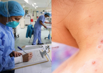 La persona sospechada con viruela símica se encuentra aislada y estable