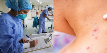 La persona sospechada con viruela símica se encuentra aislada y estable