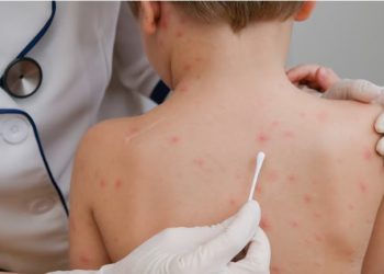 Brote de sarampión: quiénes deben vacunarse y dónde se aplican las dosis