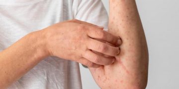 Brote de sarampión en México: se registran 31 muertos y suben los contagios