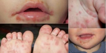 Virus “manos, pies y boca” en Jujuy: lo que tenés que saber para proteger a los chicos