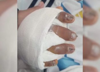 El alumno palpaleño que sufrió el accidente con el ventanal tiene el 95% de la mano destruida