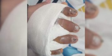 El alumno palpaleño que sufrió el accidente con el ventanal tiene el 95% de la mano destruida