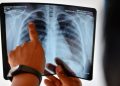 Alerta por tuberculosis: en lo que va de 2026 hubo 1.225 casos más que el promedio para esta época