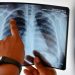 Alerta por tuberculosis: en lo que va de 2026 hubo 1.225 casos más que el promedio para esta época